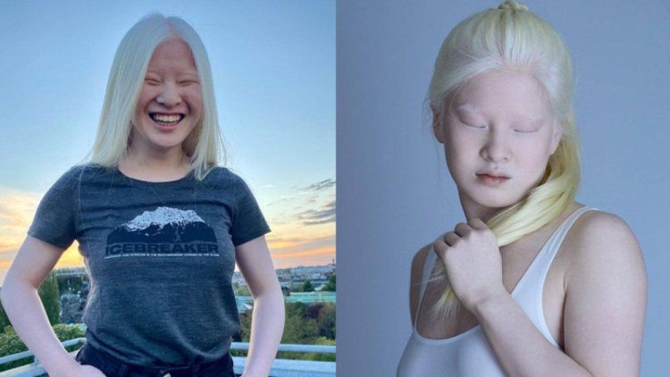 18 Tahun Lalu Ditinggalkan di Panti Asuhan,Gadis Albino Mujur jadi Model,Mejeng di Majalah Vogue