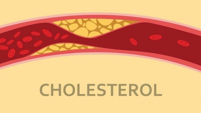 Penderita Kolesterol Baiknya Konsumsi Makanan Sehat Ini