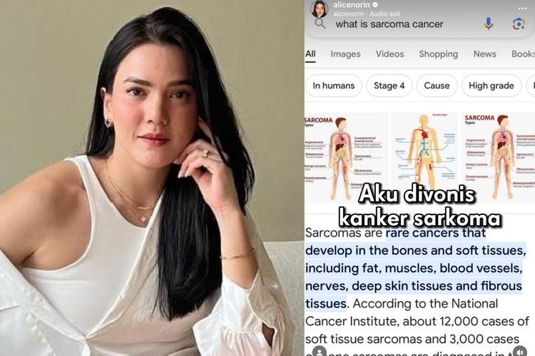 Derita Kanker Sarkoma, Alice Norin Ungkap Efek Samping Operasi: Mual dan Nyeri