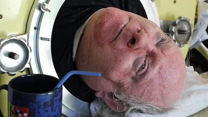Paul Alexander,Pria dengan Paru-paru Besi Meninggal Dunia pada Usia 78 Tahun