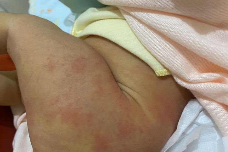 5 Obat Flu Singapura Anak di Apotek, Tanda Sembuh Bisa Cek Pipisnya