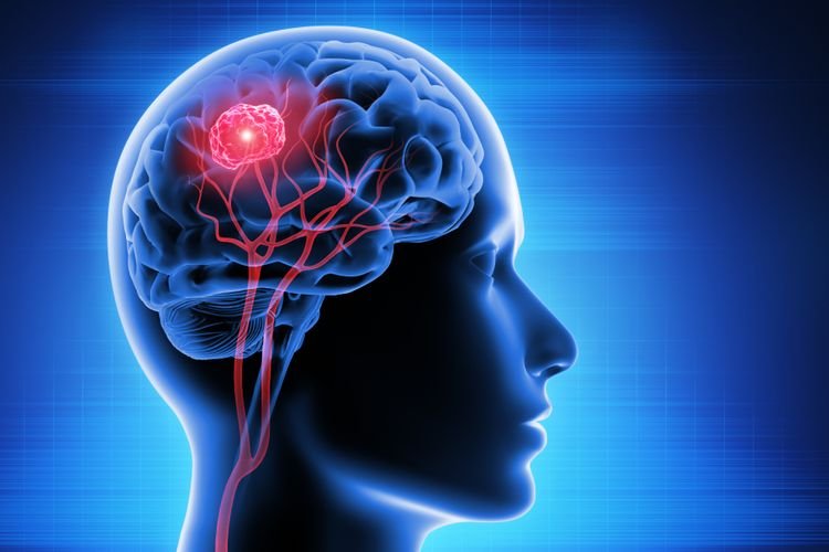Penyebab Glioblastoma, Tumor Otak Ganas yang Harus Diwaspadai